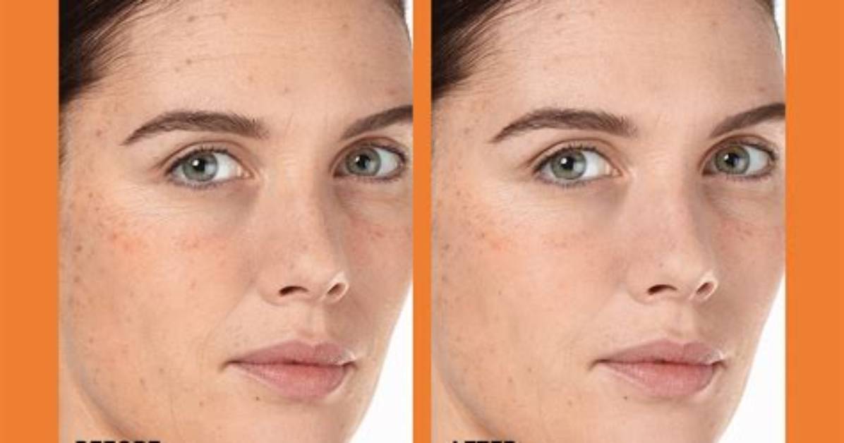Before and After at the C Spot La: Dermatologist Insights and Treatment Results