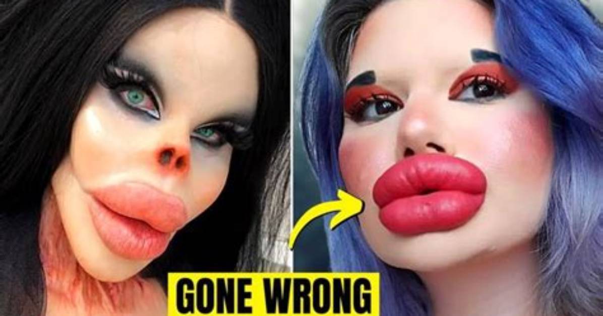 Botched Cosmetic Surgeries and the Viral 'Monsters, Inc. Lips' Phenomenon Explained