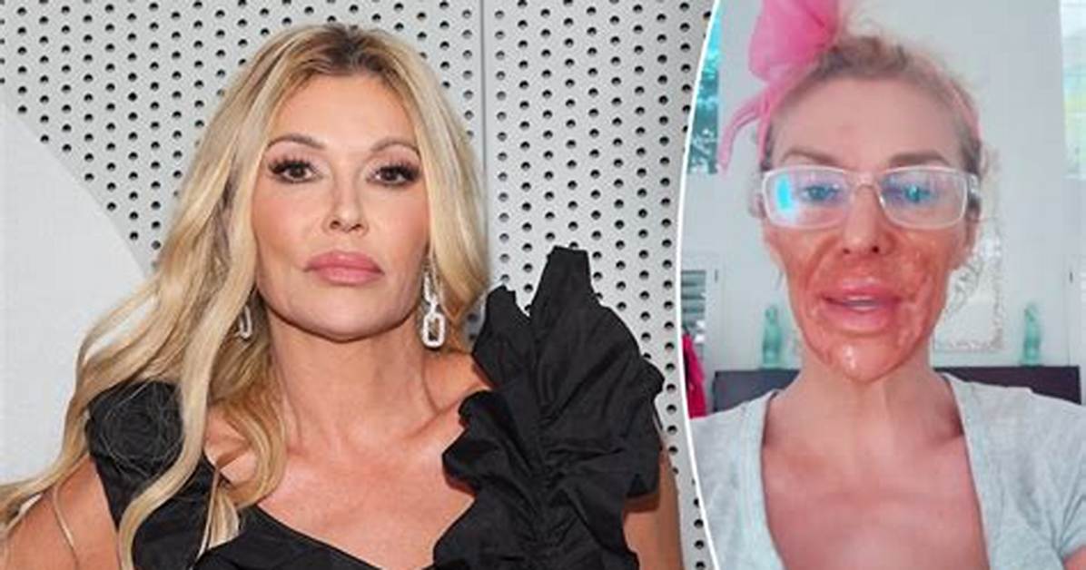 Brandi Glanville Nair Burn Incident: Timeline of the Reality Star’s Viral Video Revelation
