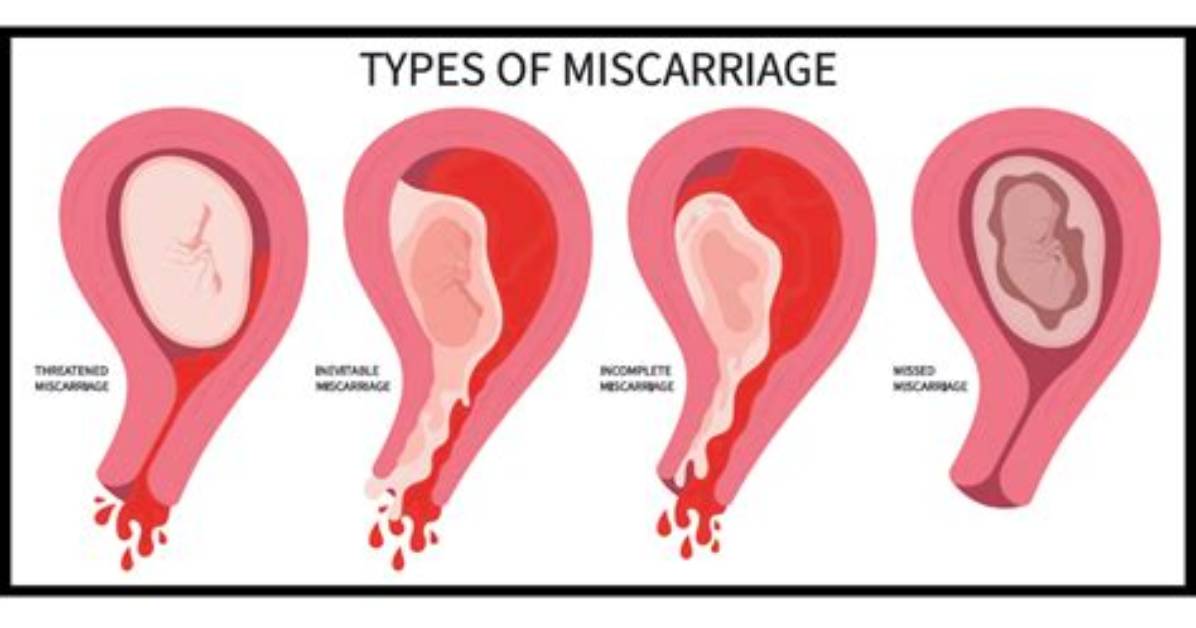 Can Lady Bloom Cause Miscarriage? the Dangerous Truth Behind Herbal Pregnancy Rumors