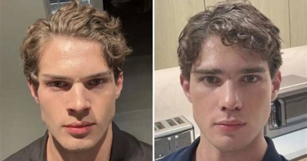Clavicular Nose Surgery Timeline: from Live Dr. Miami Operation to Viral Online Roast