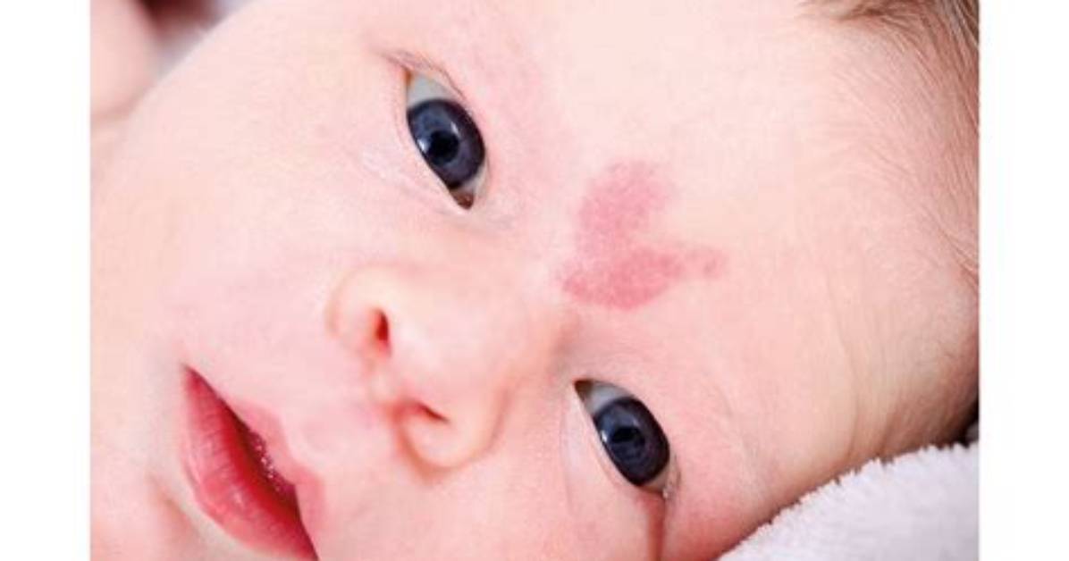 Is a Stork Bite Really a Warning Sign of Mthfr Mutation? Viral Panic Debunked
