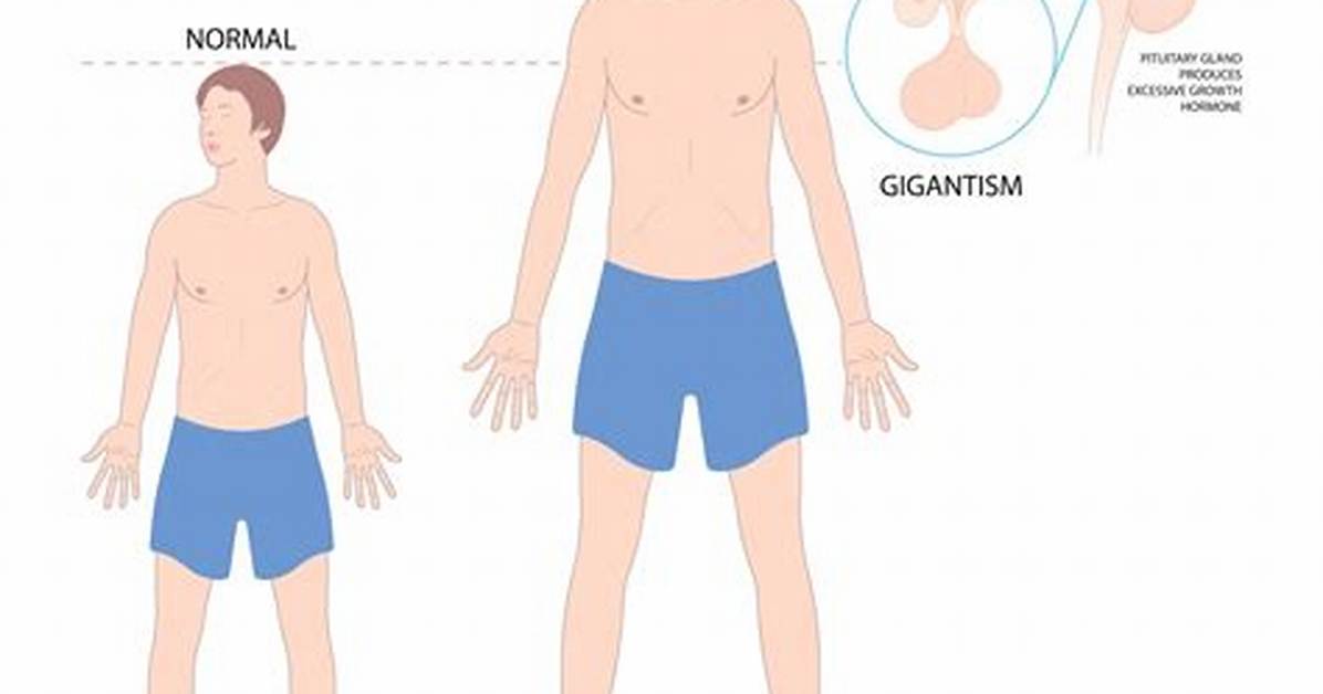 Medical Breakdown: What Pituitary Gigantism Actually Does to the Human Body