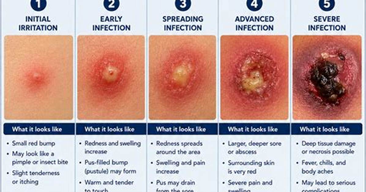 What Early Staph Looks Like: Key Visual Indicators and Skin Warning Signs