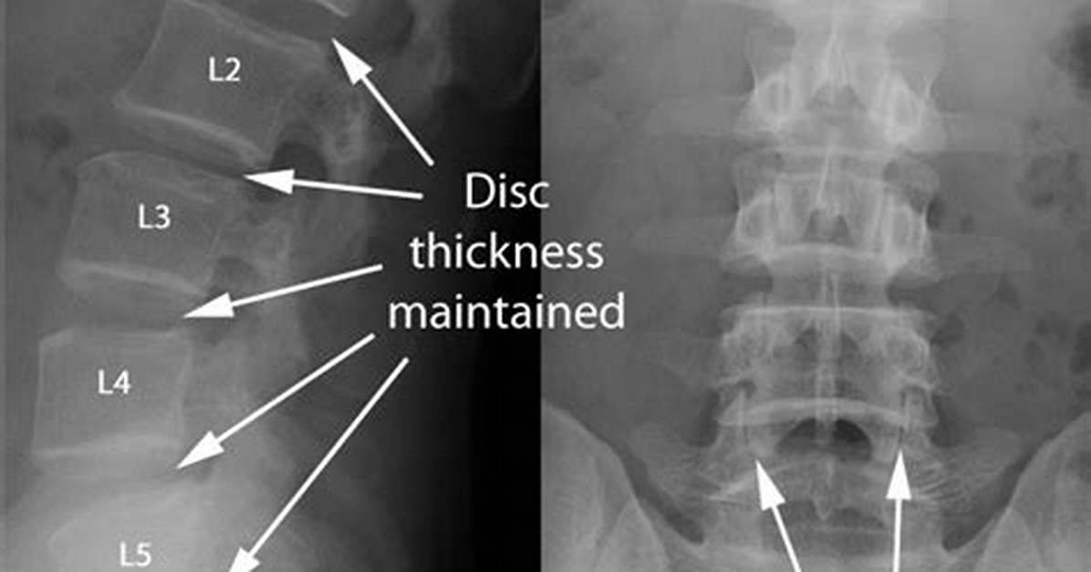 What Lumbago Looks Like on Scans: Anatomy of Acute Lower Back Pain