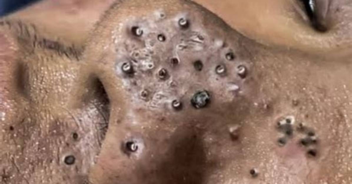 Why the Newest 2025 Nguyen Blackhead Removal Videos Are Going Insanely Viral