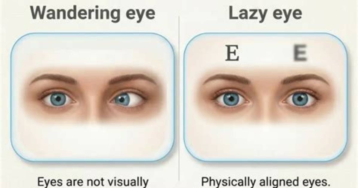 Why the 'Wandering Eye' Discourse Is Exploding Across Social Media Right Now